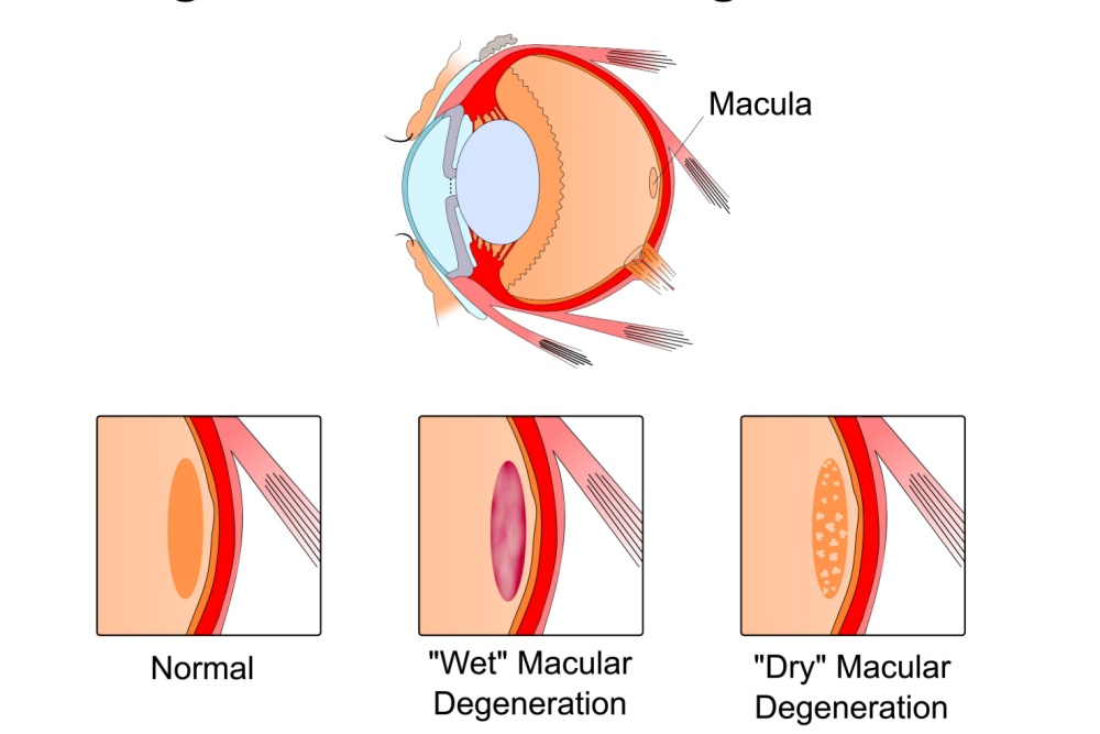 types of dry eye
